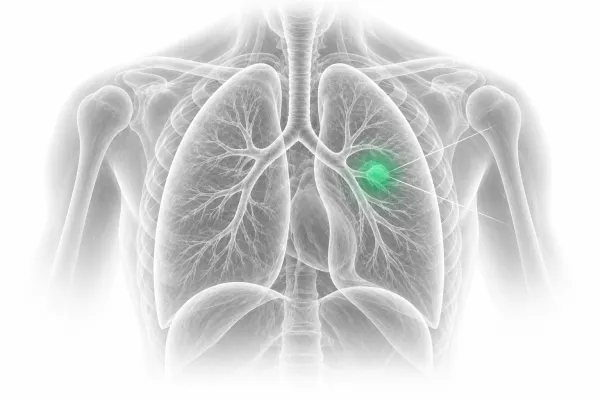 Precision Multidisciplinary Cancer Care